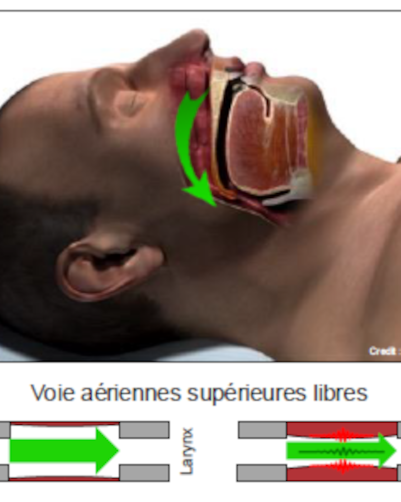 Ronflements apnées-orthèses Le Vésinet