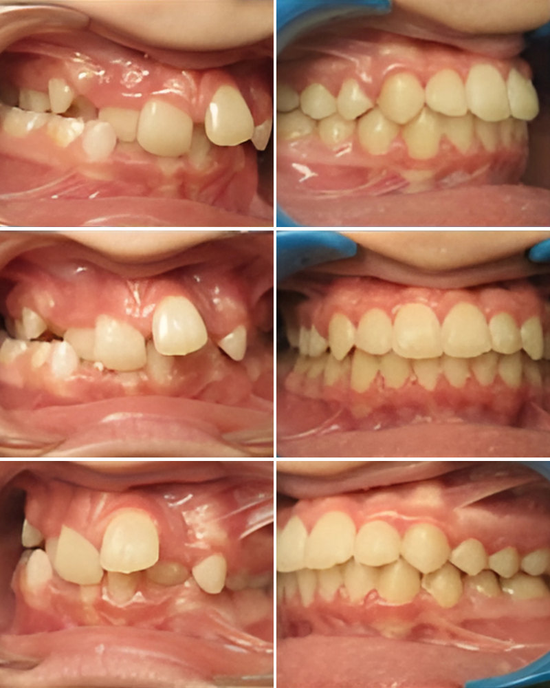 Cas cliniques orthodontie Versailles